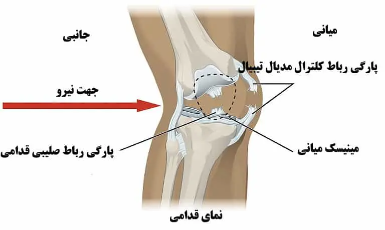 علائم پارگی مینیسک زانو